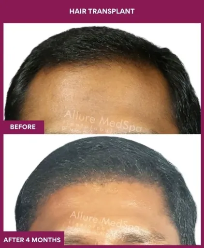 2 Hair Transplant (4)_4_