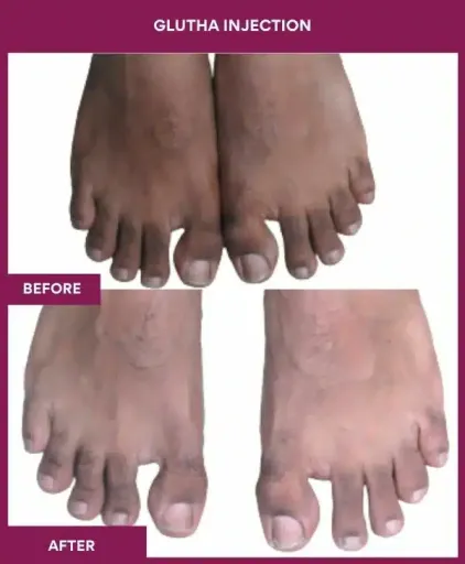 3 Glutha Injection (2)