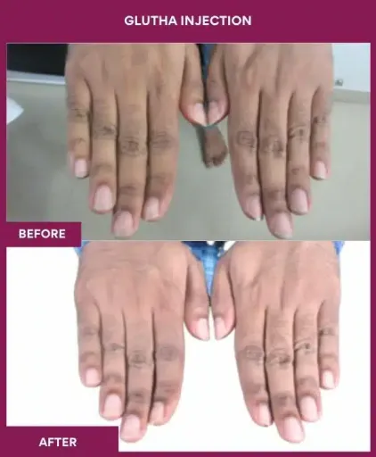 3 Glutha Injection (3)