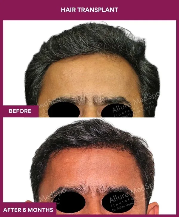 3 Hair Transplant_8 (1)