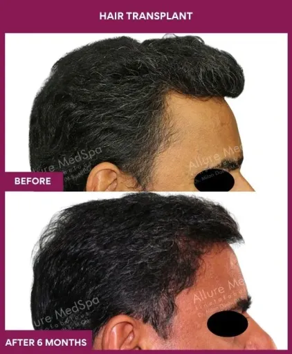 3 Hair Transplant_8 (2)