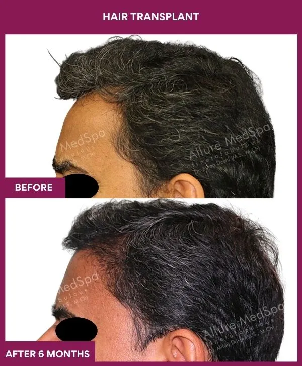 3 Hair Transplant_8 (3)