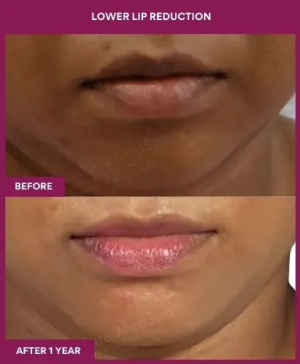 3 LOWER LIP REDUCTION (3)_