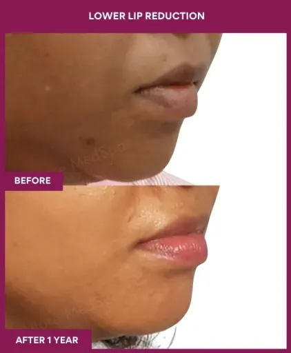 3 LOWER LIP REDUCTION (4)_