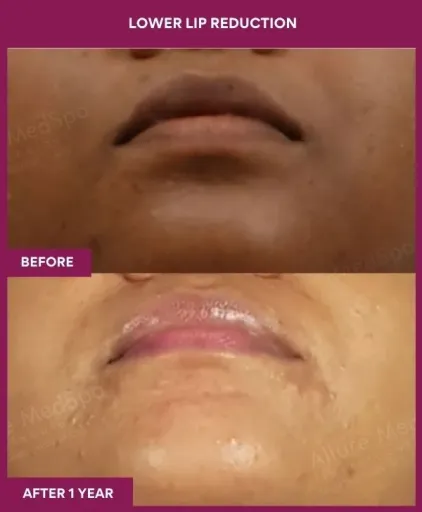 3 LOWER LIP REDUCTION (5)_