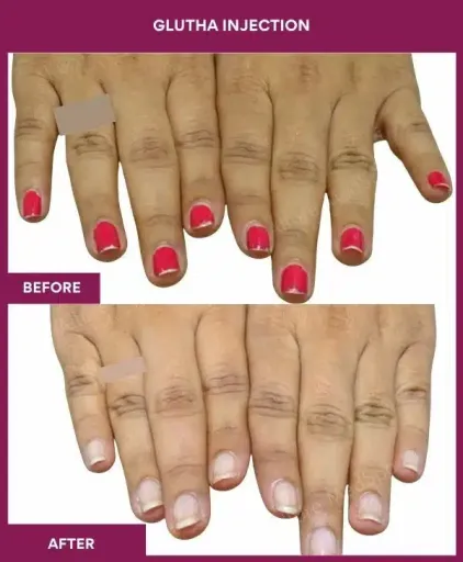 4 Glutha Injection (2)