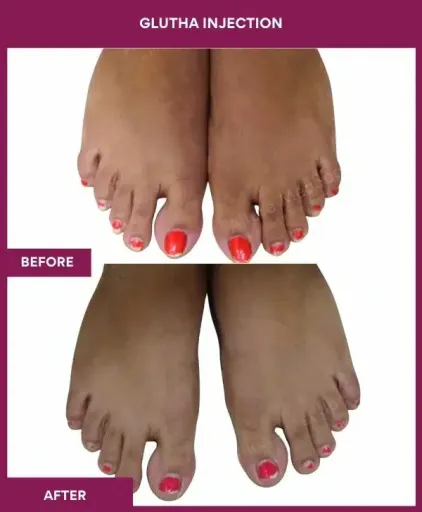 4 Glutha Injection (3)