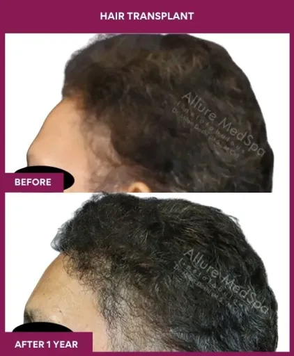 4 Hair Transplant (3)_10_