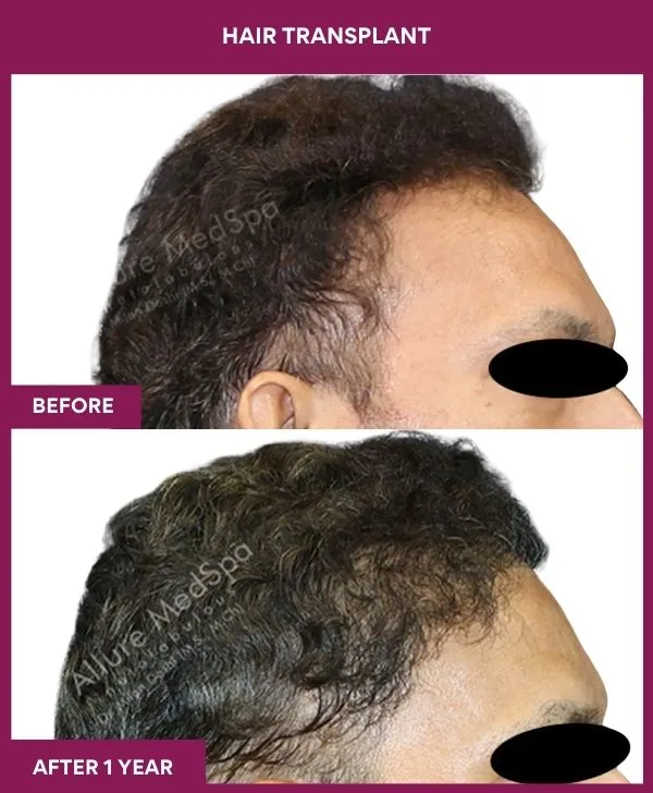 4 Hair Transplant (5)_10_
