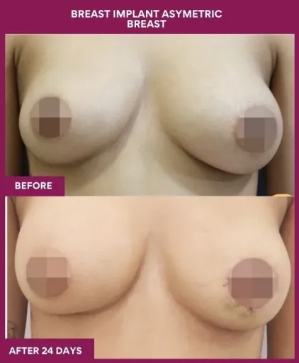 5 Breast implant asymetric breast_15_ (1)