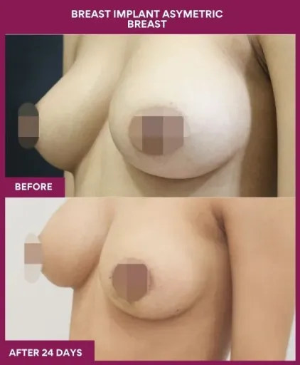 5 Breast implant asymetric breast_15_ (3)