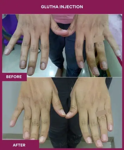 5 Glutha Injection (2)