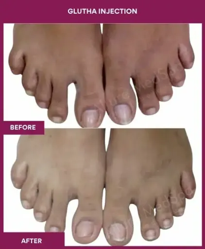 5 Glutha Injection (3)