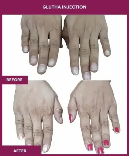 6 Glutha Injection (2)