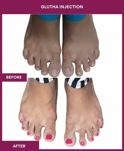 6 Glutha Injection (3)