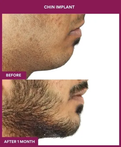 7 Chin Implant (5)_20_