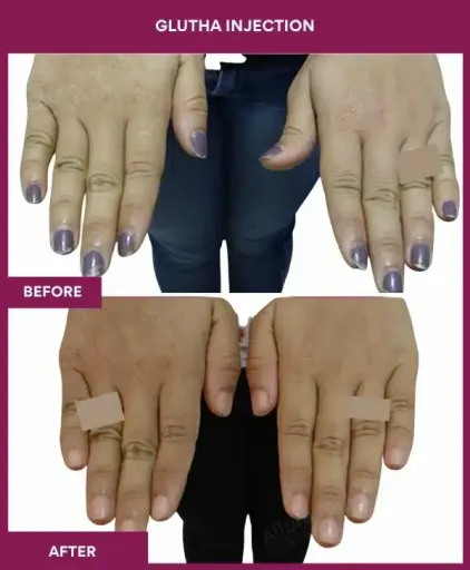 7 Glutha Injection (2)