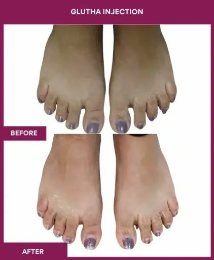 7 Glutha Injection (3)