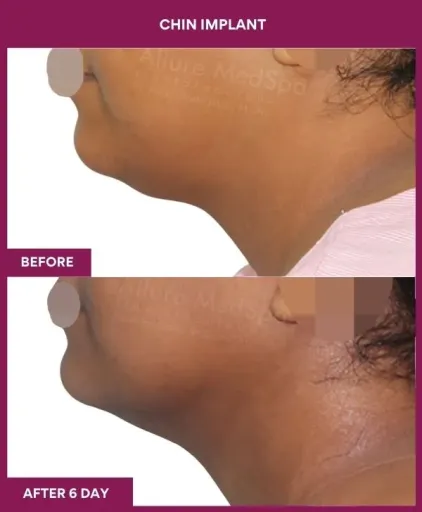 8 Chin Implant ) (3)_19_