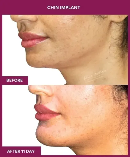 8 Chin Implant (3)_23_