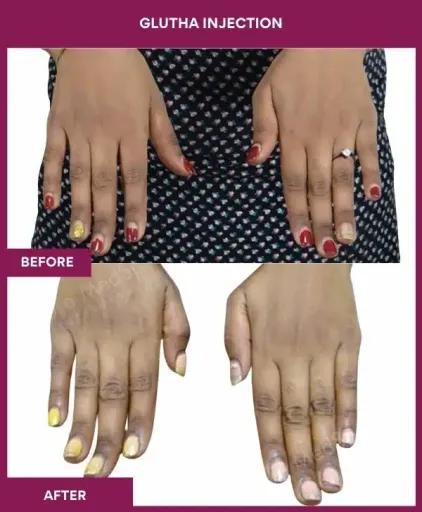 8 Glutha Injection (2)