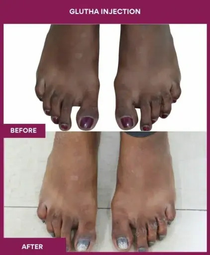 8 Glutha Injection (3)