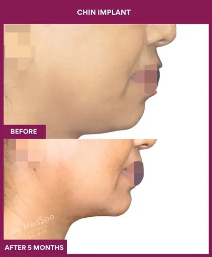 9 Chin Implant (5)_26_
