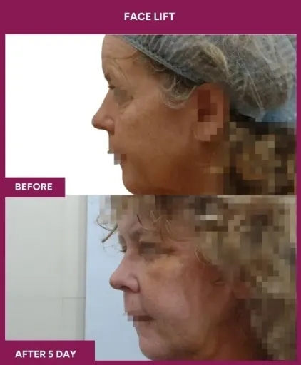9 FACE LIFT_20_ (3)