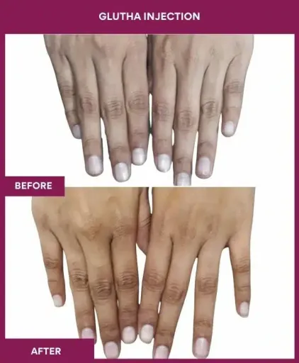 9 Glutha Injection (2)