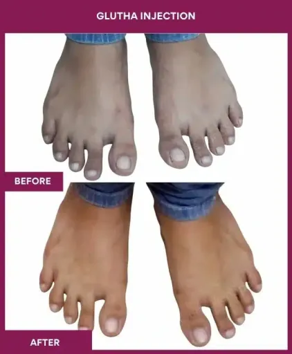 9 Glutha Injection (3)