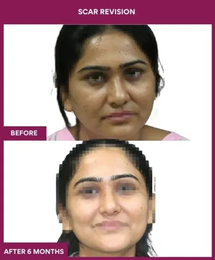 9 Scar Revision (4)_14_