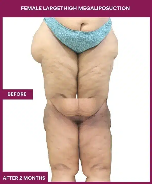 FEMALE LARGE THIGH MEGA LIPOSUCTION in Mumbai, India
