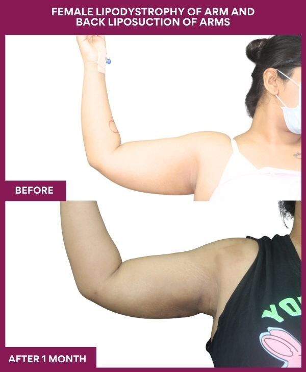 FEMALE LIPODYSTROPHY OF ARM AND BACK LIPOSUCTION OF ARMS in Mumbai, India