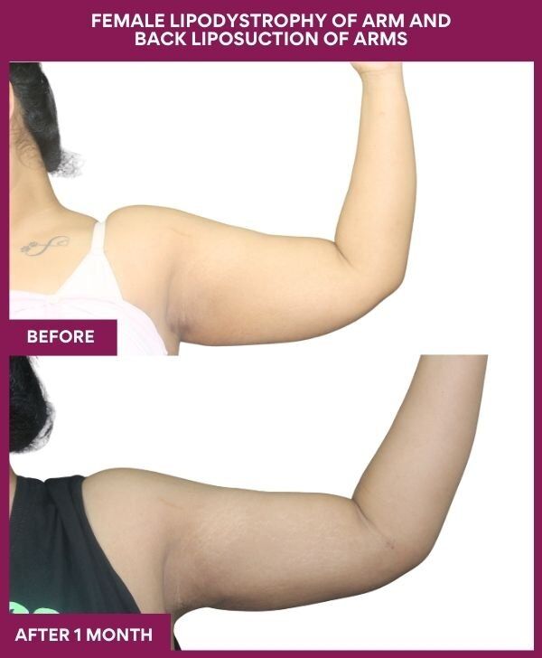 FEMALE LIPODYSTROPHY OF ARM AND BACK LIPOSUCTION OF ARMS in Mumbai, India
