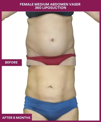 FEMALE MEDIUM ABDOMEN VASER 360 LIPOSUCTION in Mumbai, India