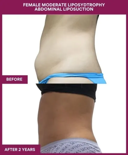 FEMALE MODERATE LIPOSYDTROPHY ABDOMINAL LIPOSUCTION in Mumbai, India