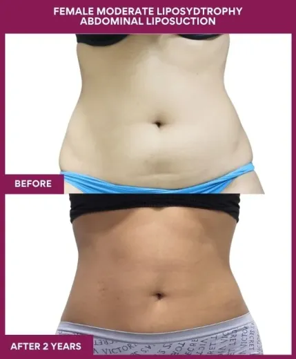 FEMALE MODERATE LIPOSYDTROPHY ABDOMINAL LIPOSUCTION in Mumbai, India