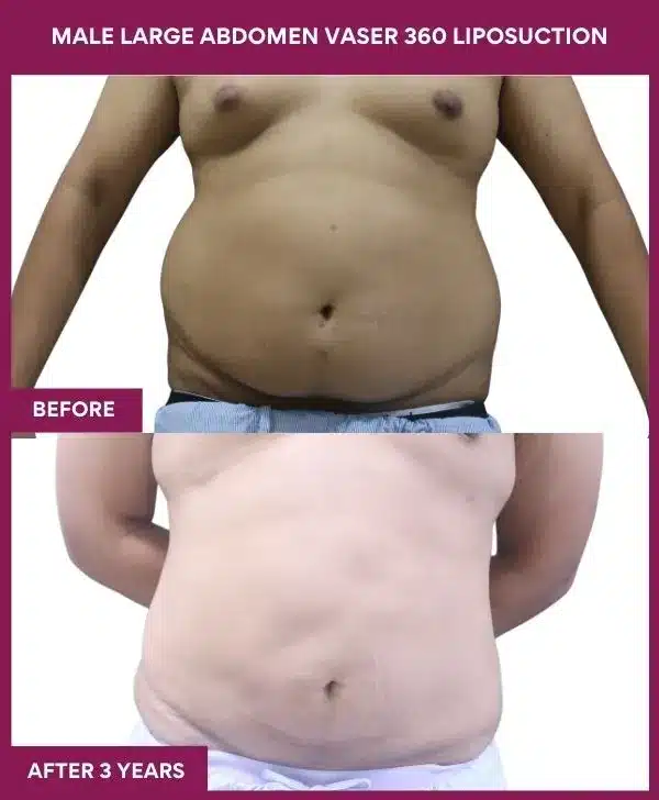 MALE LARGE ABDOMEN VASER 360 LIPOSUCTION in Mumbai, India