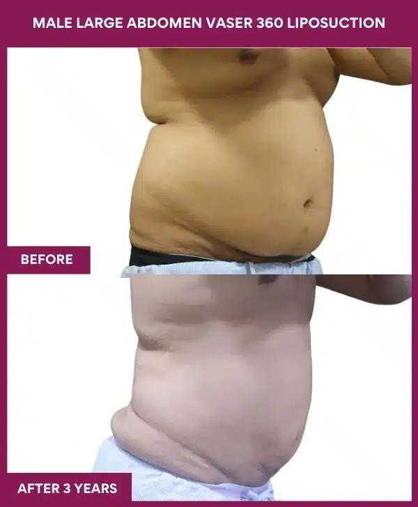 MALE LARGE ABDOMEN VASER 360 LIPOSUCTION in Mumbai, India
