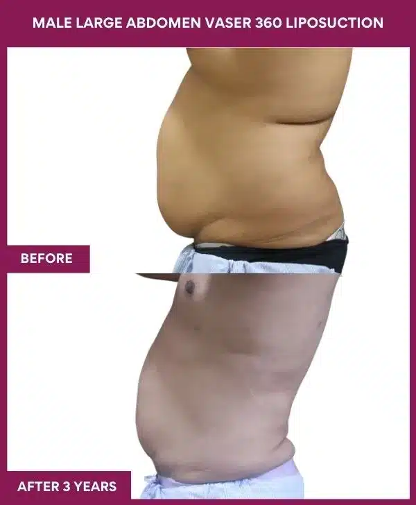 MALE LARGE ABDOMEN VASER 360 LIPOSUCTION in Mumbai, India