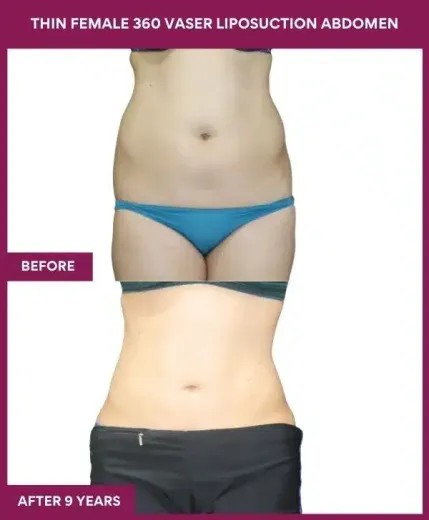 THIN FEMALE 360 VASER LIPOSUCTION ABDOMEN (4)_96_