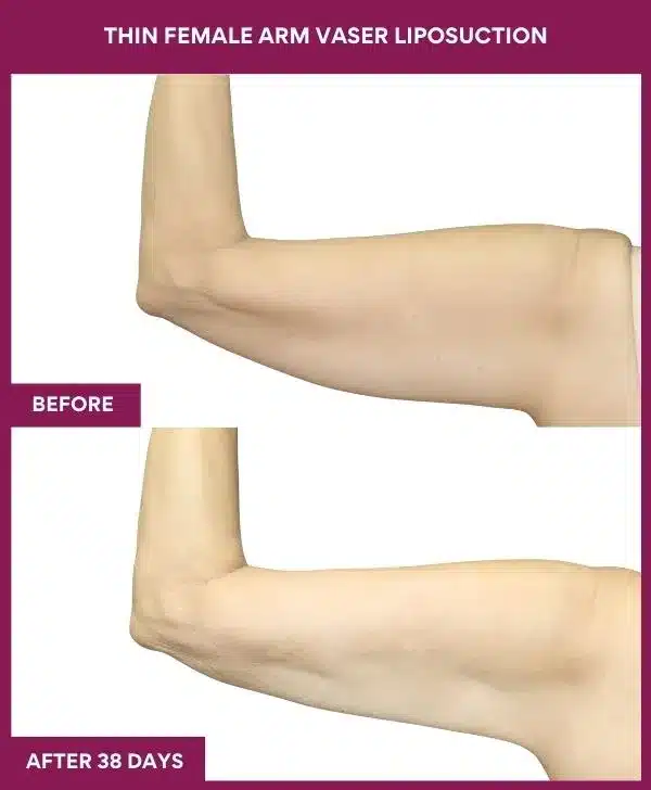 THIN FEMALE ARM VASER LIPOSUCTION in Mumbai, India
