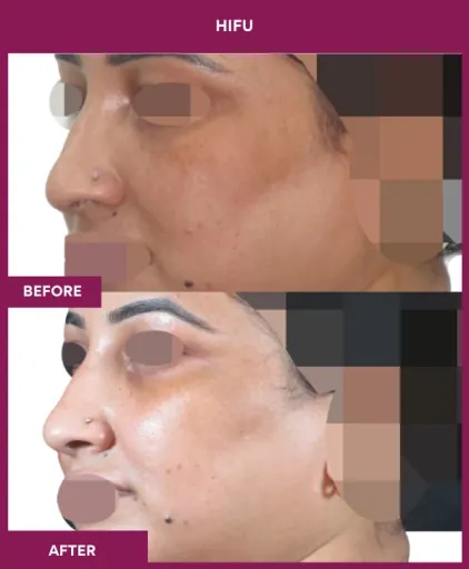 Hifu Treatment in Mumbai