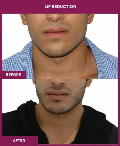 10 LIP REDUCTION