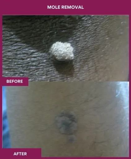 10 Mole Removal