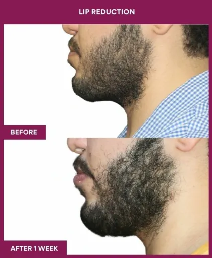 11 LIP REDUCTION (2)