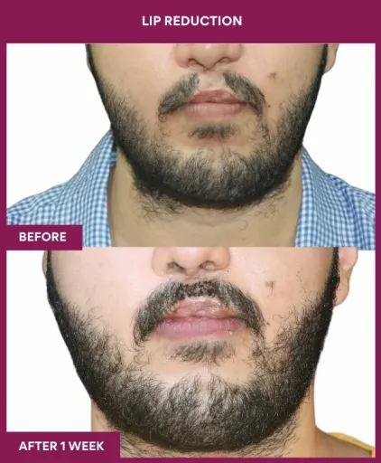 11 LIP REDUCTION (3)