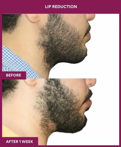 11 LIP REDUCTION (4)