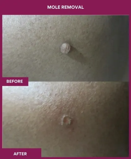 11 Mole Removal