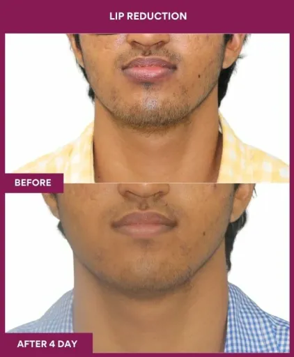12 LIP REDUCTION